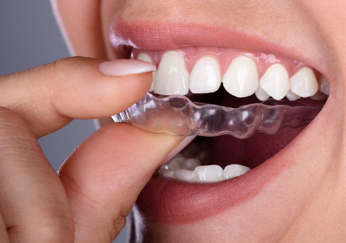 Aligners Result
