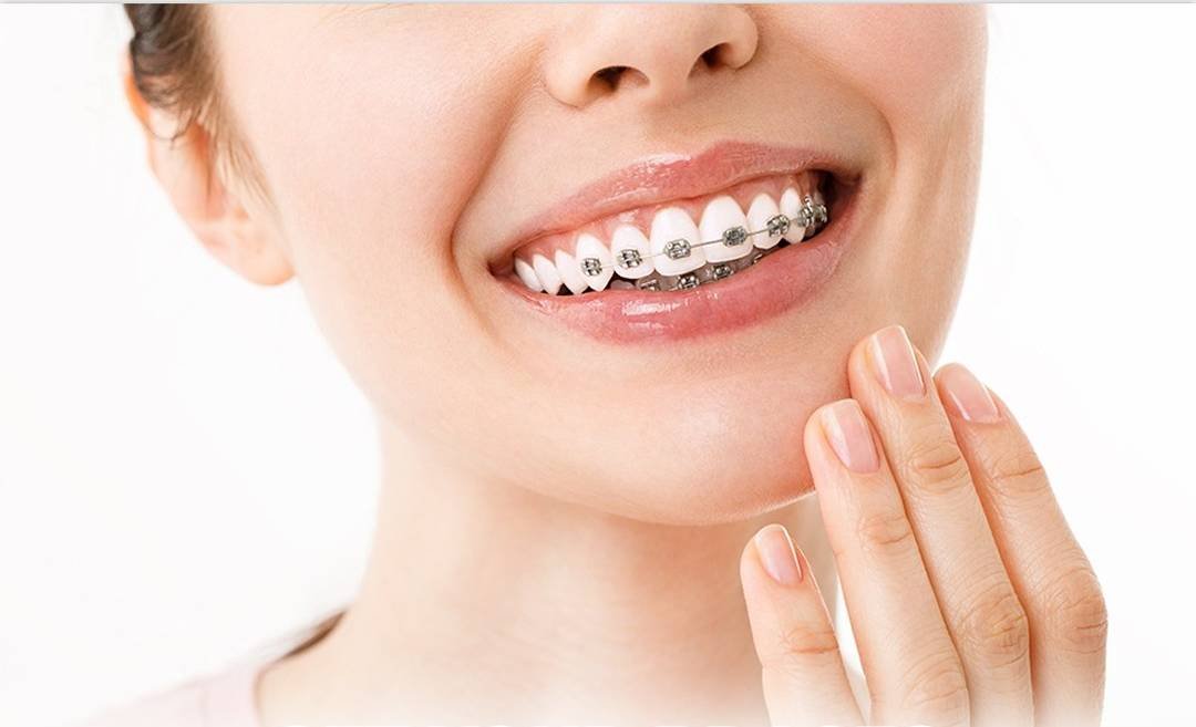 Braces
