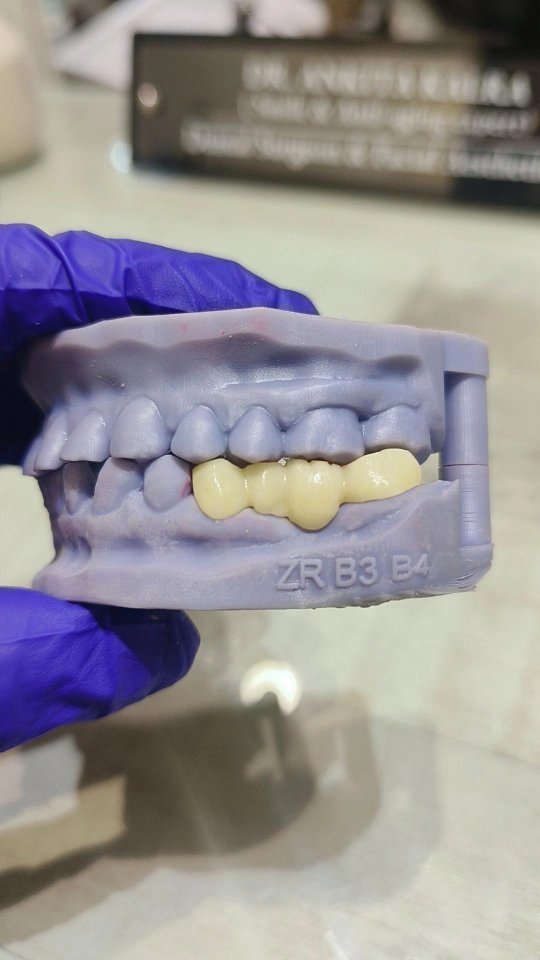 Crowns & Capping