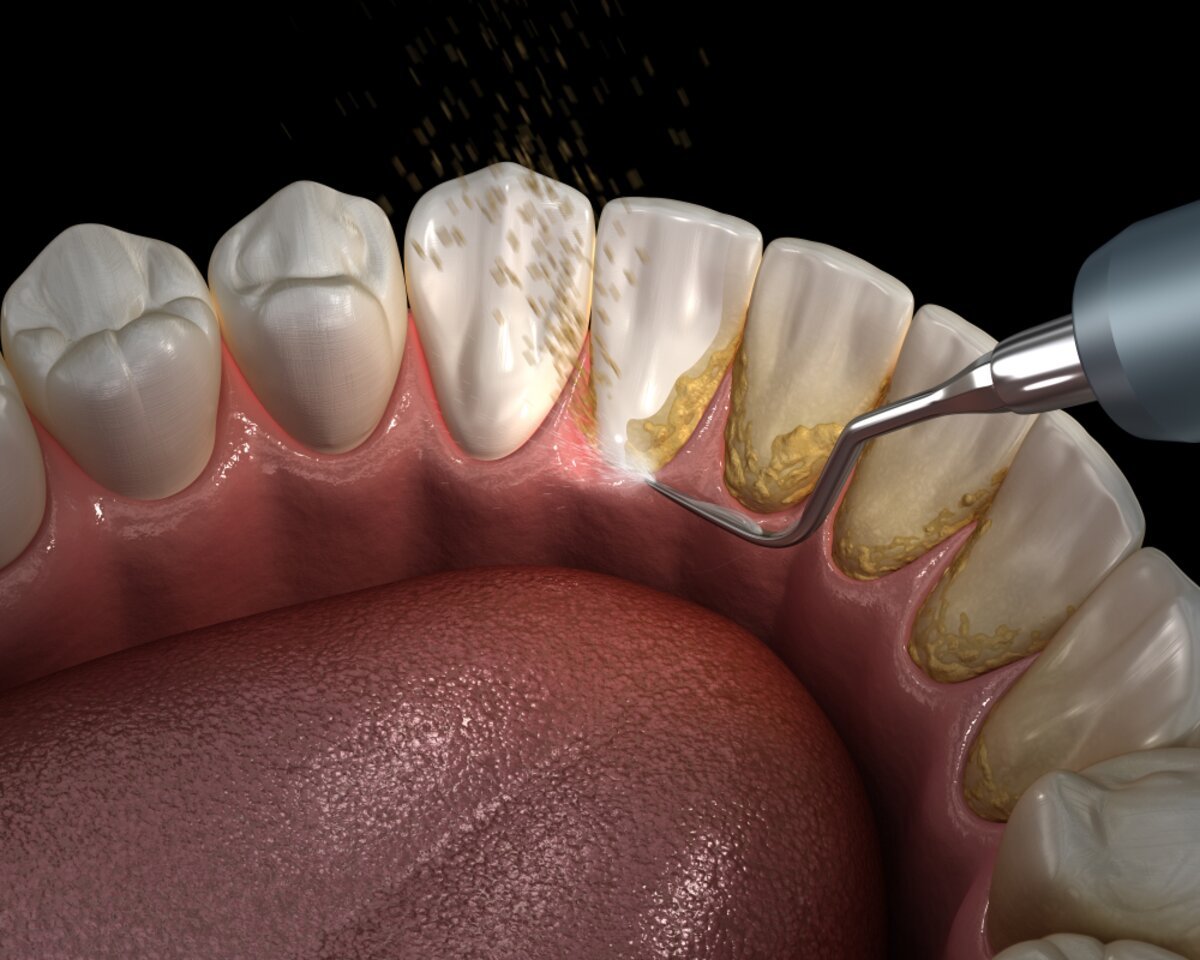 Dental Restorations Result