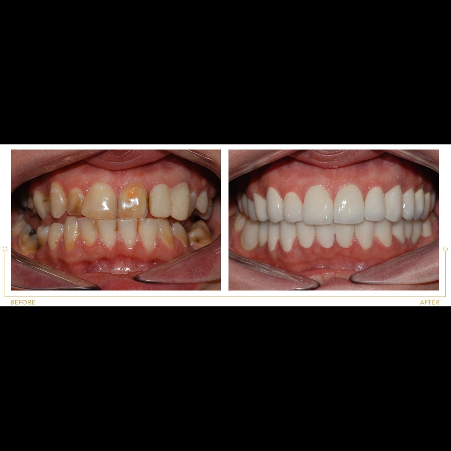 Full Mouth Rehabilitation
