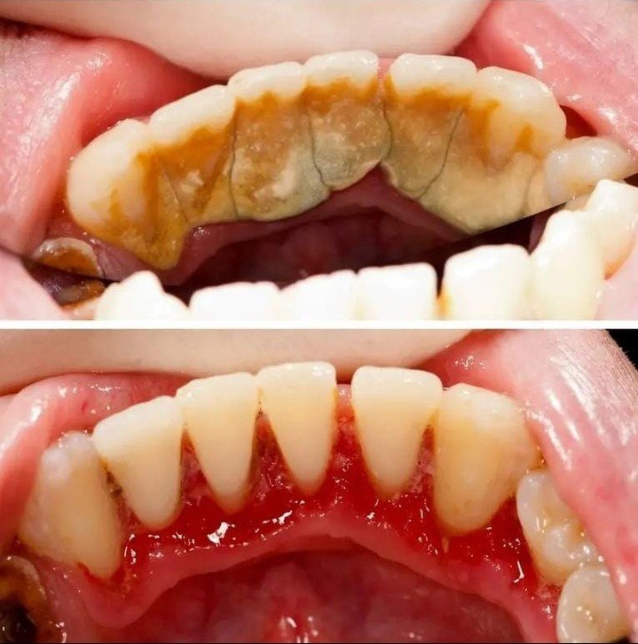 Scaling / Cleaning
