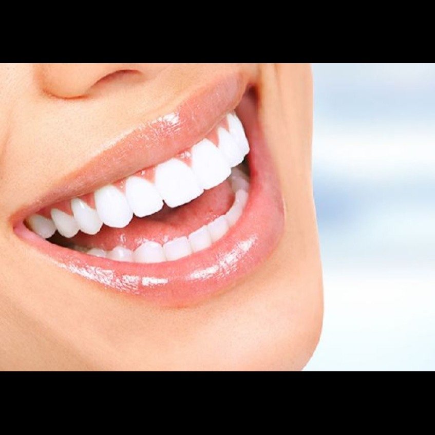 Smile Makeover Result