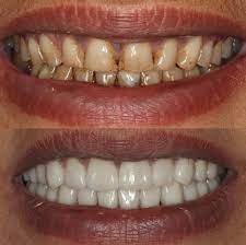 Teeth Whitening Result