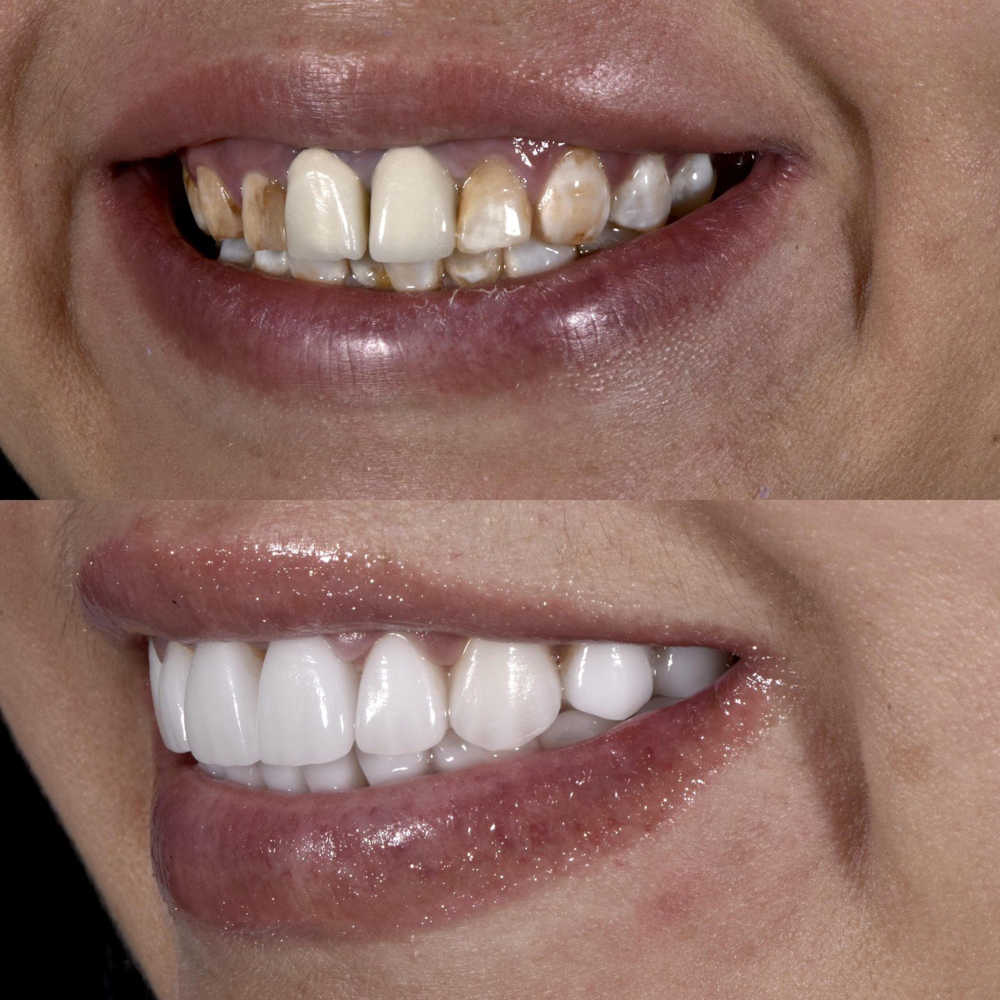 Teeth Whitening