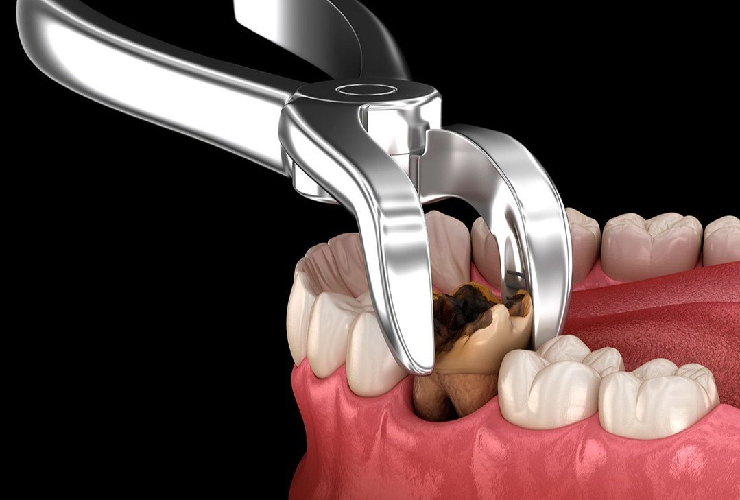 Tooth Extraction