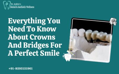 Everything You Need To Know About Crowns And Bridges For A Perfect Smile