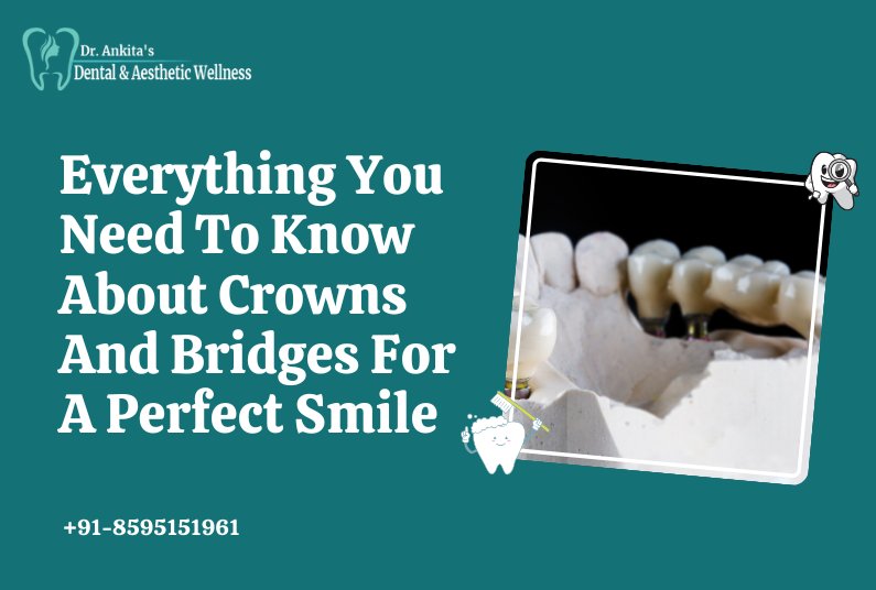 Everything You Need To Know About Crowns And Bridges For A Perfect Smile